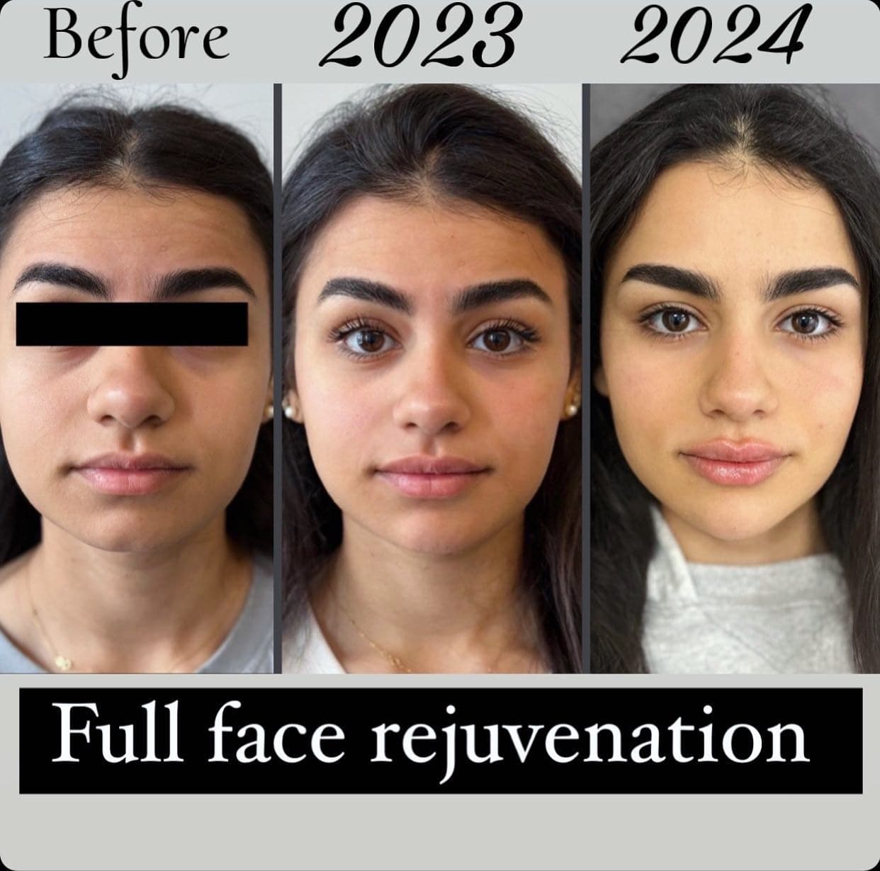 Full face rejuvenation over two years, three front views labelled before, 2023 and 2024: gradual balancing of the features