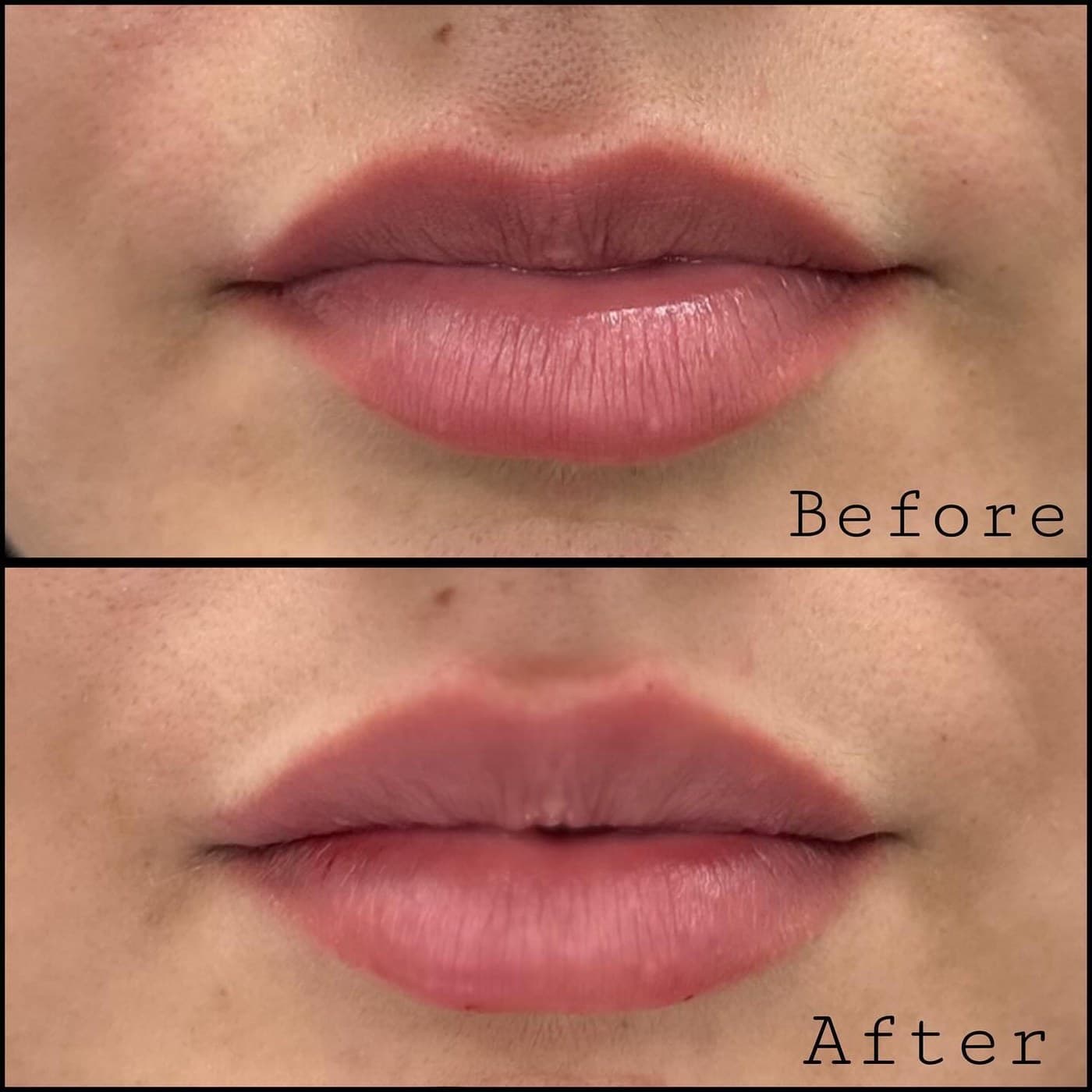 Lip filler, before and after close-up of the lips: added volume and a more defined border