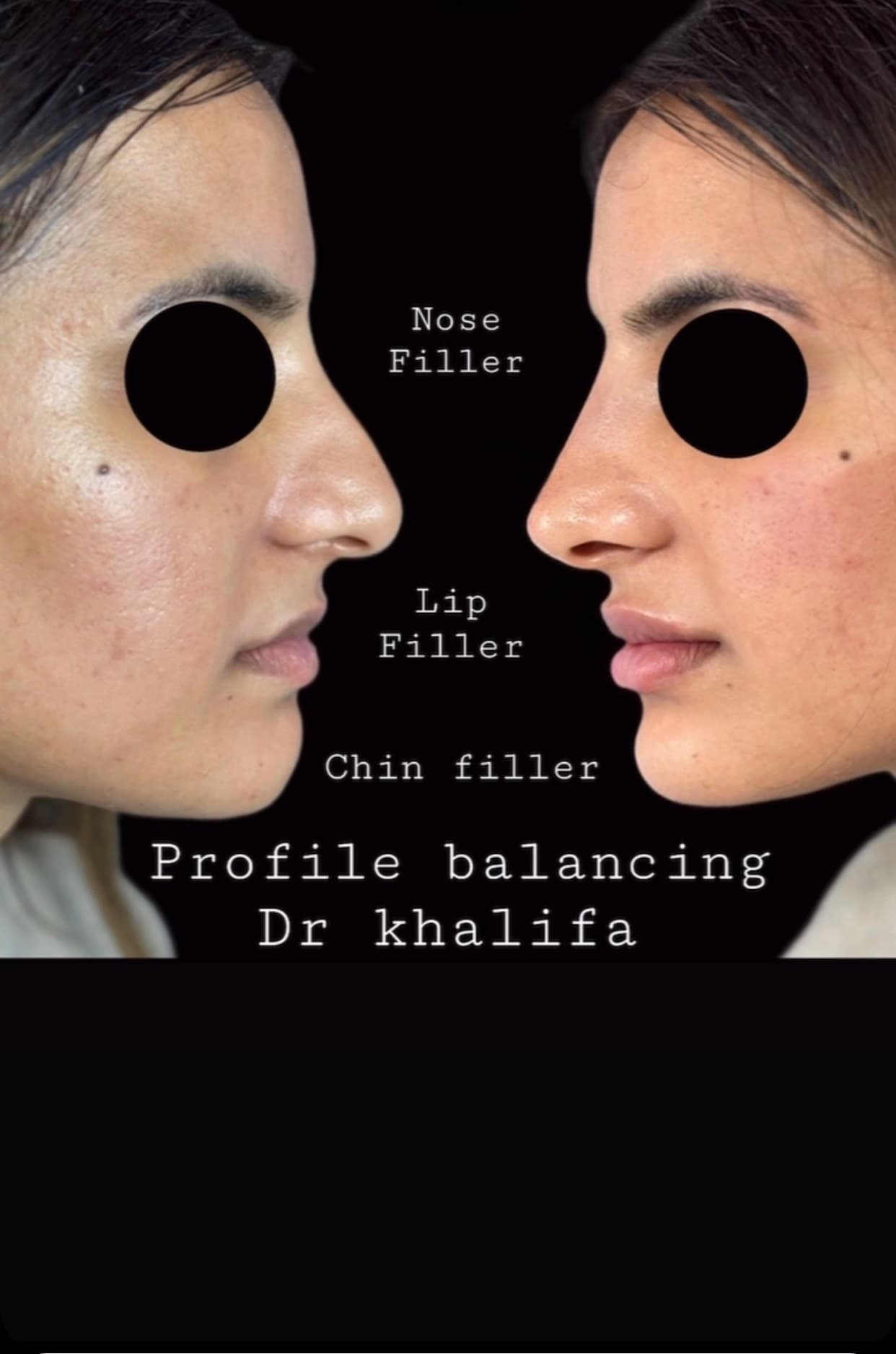 Profile balancing by Dr Khalifa, before and after side profiles with the eyes masked: nose filler, lip filler and chin filler bring the features into line
