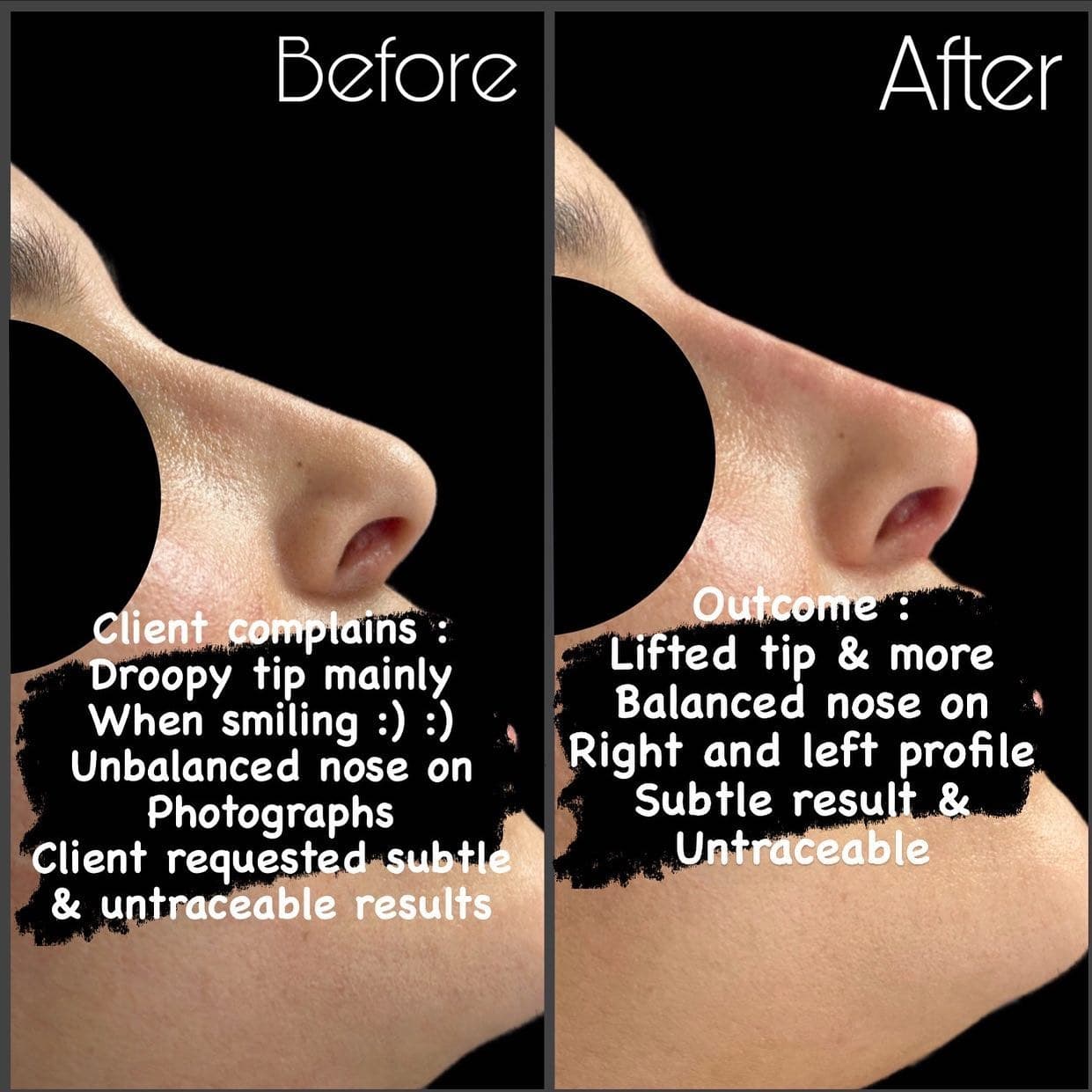 Non-surgical rhinoplasty close-up, before and after with the eyes masked, annotated: a droopy tip when smiling, lifted and balanced on both profiles