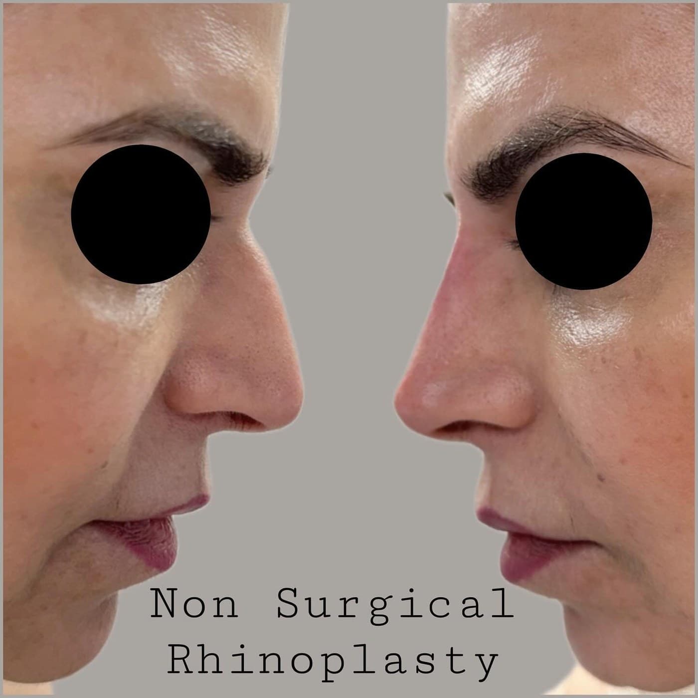 Non-surgical rhinoplasty, before and after side profiles with the eyes masked: the bump on the bridge of the nose is smoothed and the tip lifted