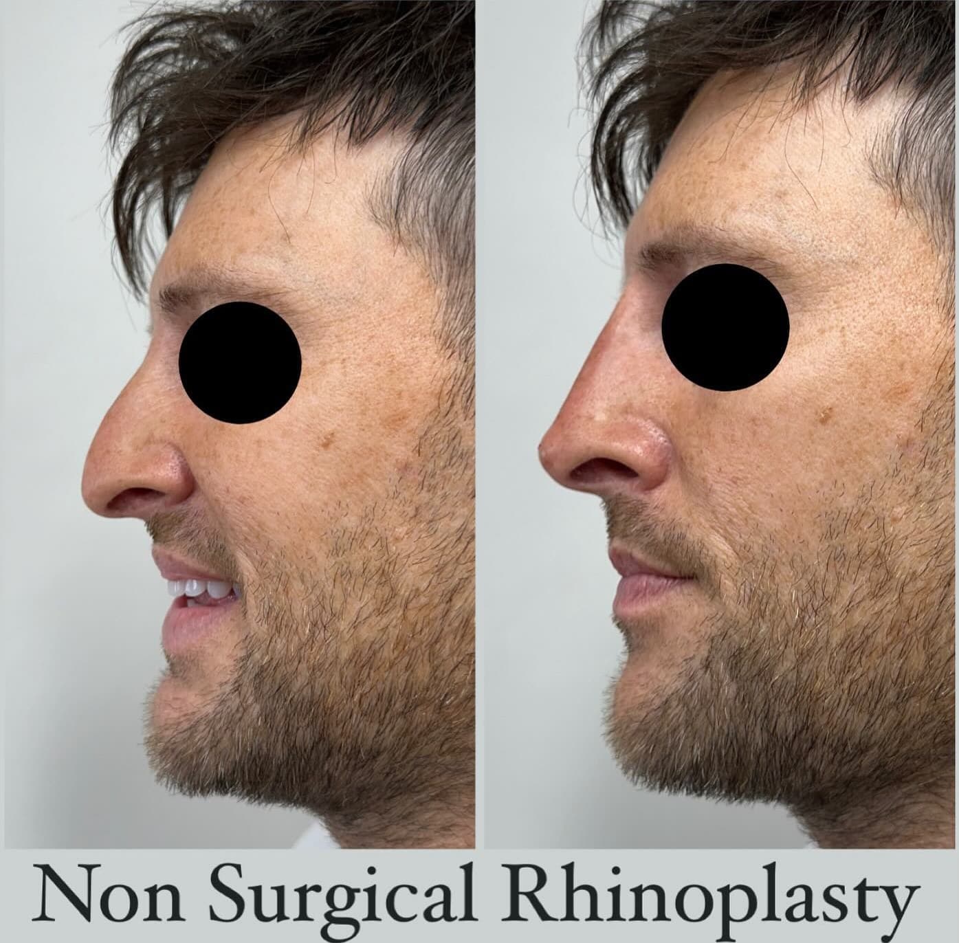 Non-surgical rhinoplasty on a man, before and after side profiles with the eyes masked: the dip in the bridge is filled and the profile straightened