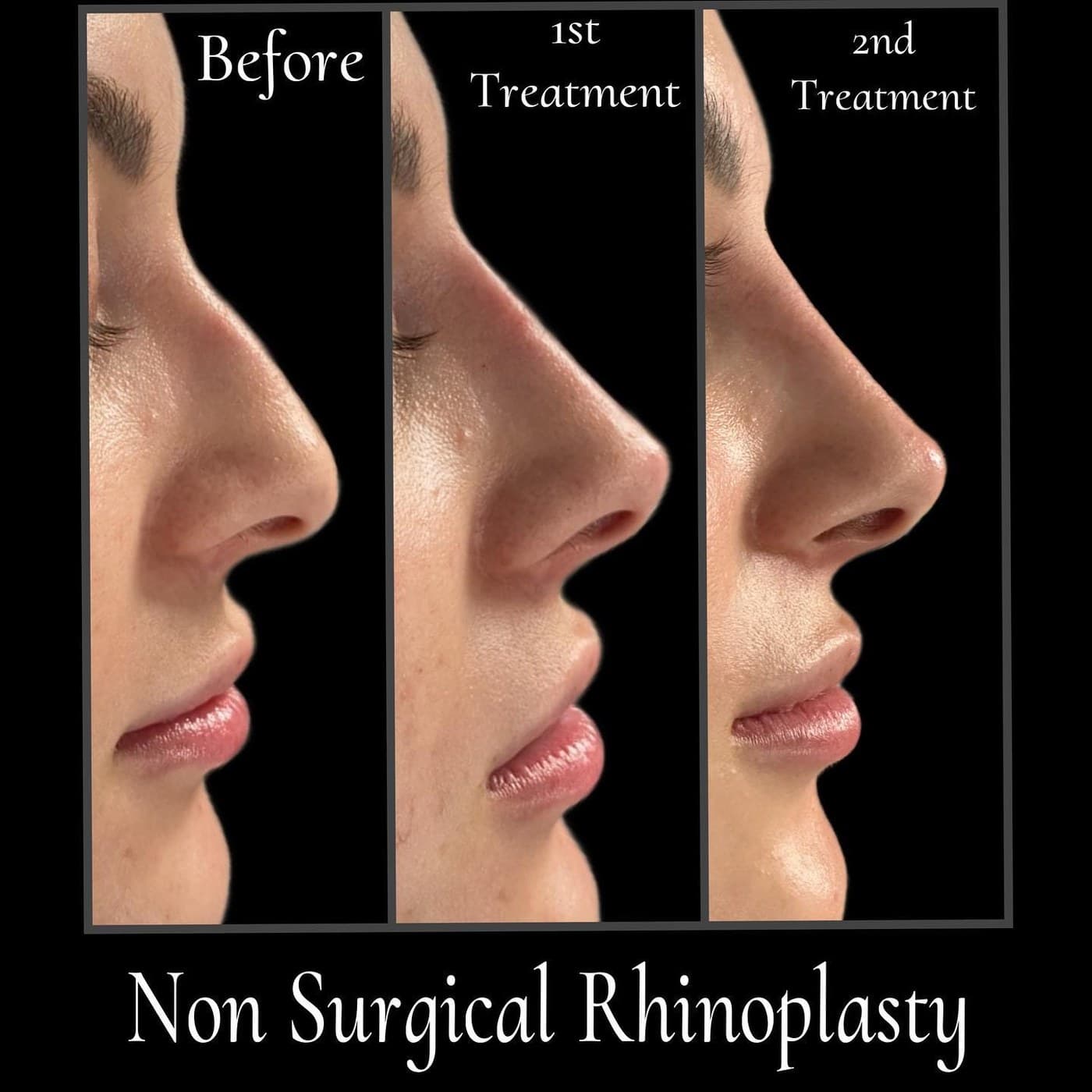 Non-surgical rhinoplasty in two treatments, three side profiles labelled before, first treatment and second treatment: the profile straightened in stages